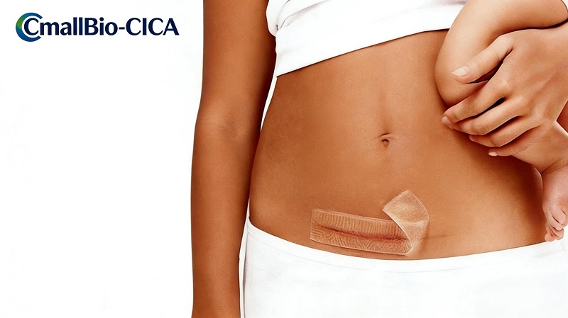 Το CmallBio Thickened Silicone Scar Patch (CmallBio-CICA) έχει εξαιρετική απόδοση πρόσφατα, σταθεροποιώντας τη θέση του στην κορυφαία βαθμίδα του πεδίου αφαίρεσης ουλών από ιατρική σιλικόνη